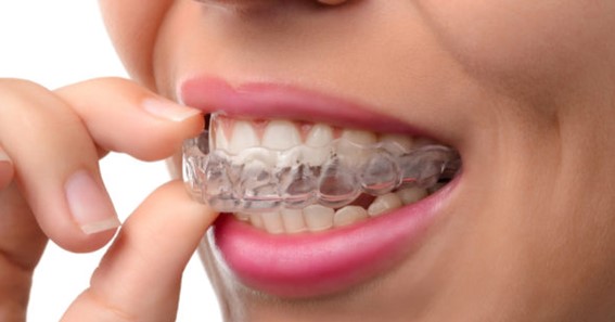 What Is Invisalign Teen